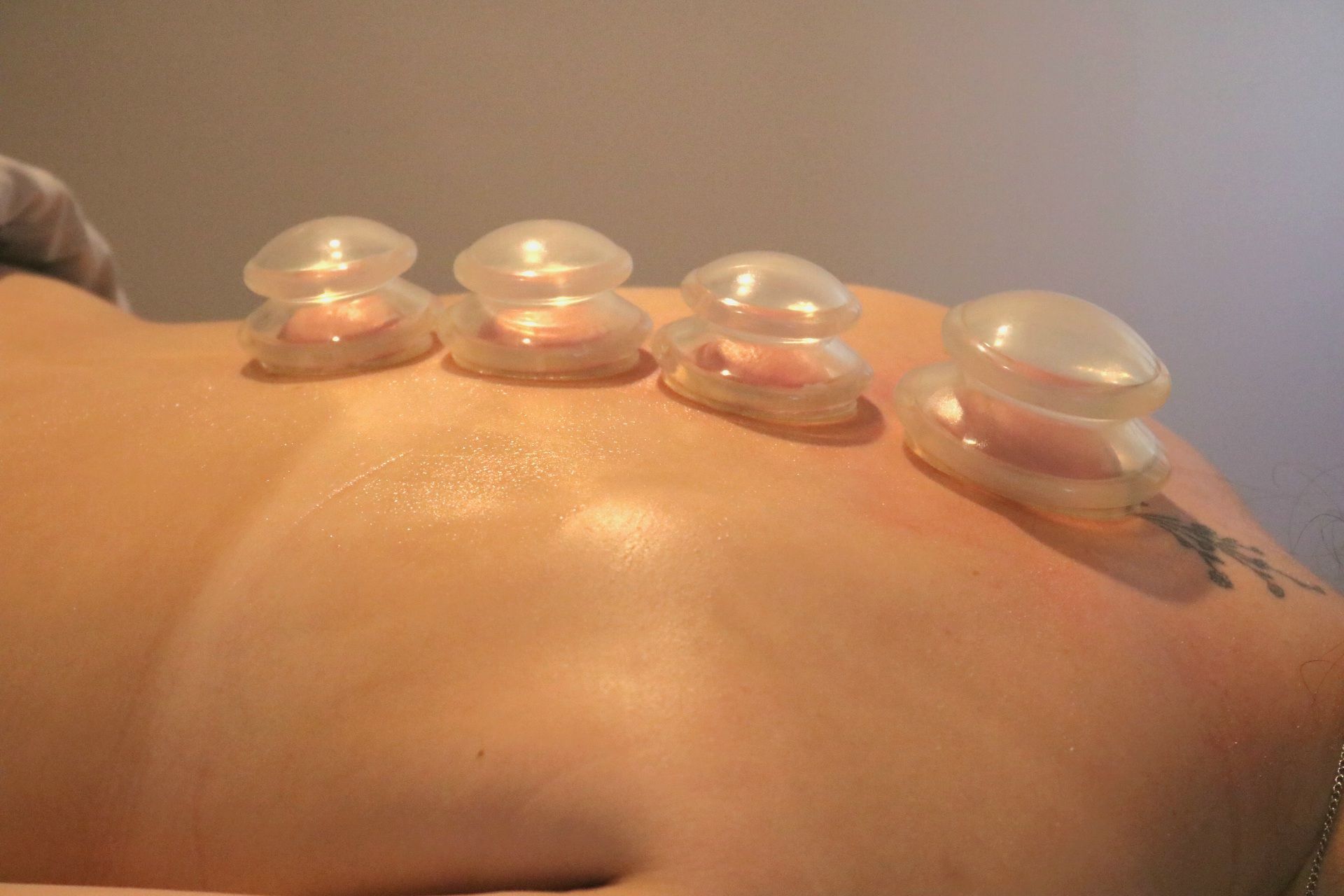 cupping therapy